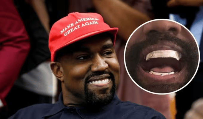 Kanye West Causa Revuelo con su Nueva Dentadura de Titanio