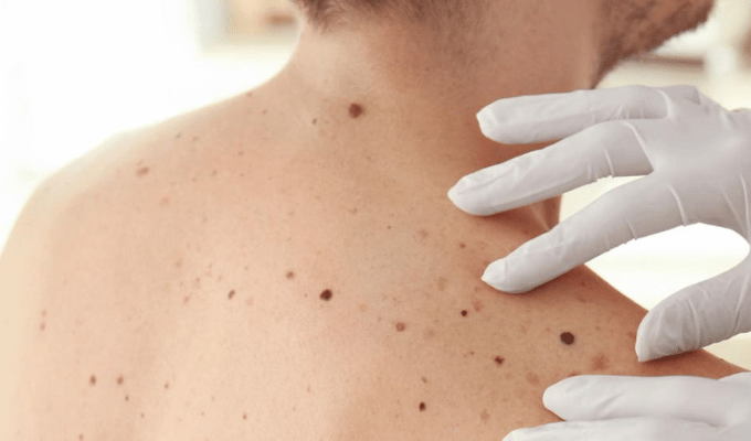 Cifras en Ascenso de Cáncer de Piel en Ecuador – Guía de Prevención