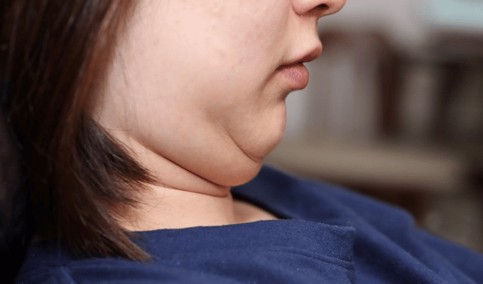 Despídete de la Papada: Secretos Naturales para un Cuello Estilizado