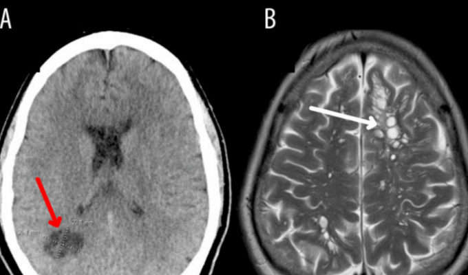Encuentran larvas parasitarias en cerebro de paciente con migrañas