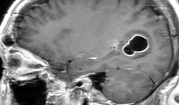 Larvas en el Cerebro por Consumir Cerdo Poco Cocido
