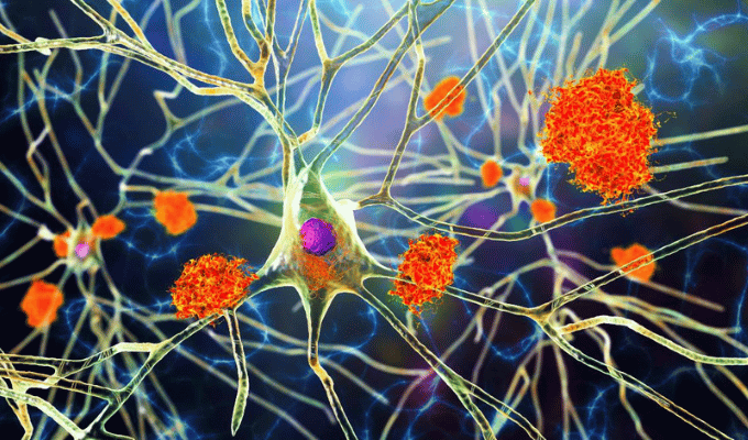 Identifican Biomarcador Clave para el Diagnóstico Precoz del Alzheimer