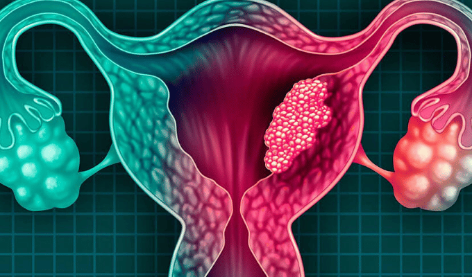 Detectar Síntomas del Cáncer de Cuello Uterino a Tiempo Salva Vidas