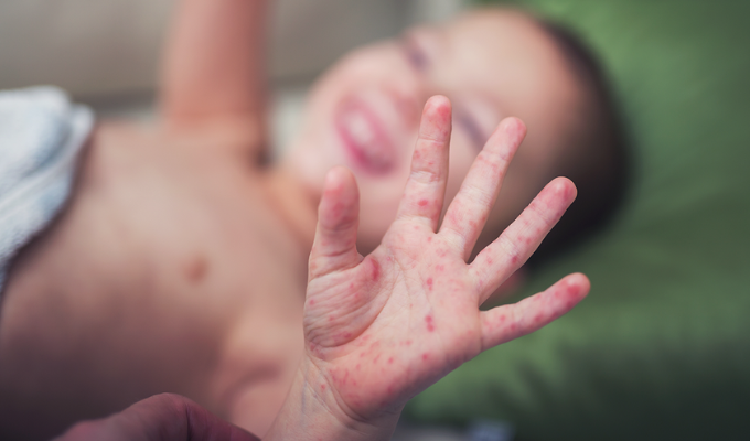 Aumento de casos de 'manos, pies boca' en niños en Guayaquil 🚨