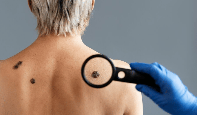 Melanoma: consejos de expertos para prevenir y detectar este cáncer