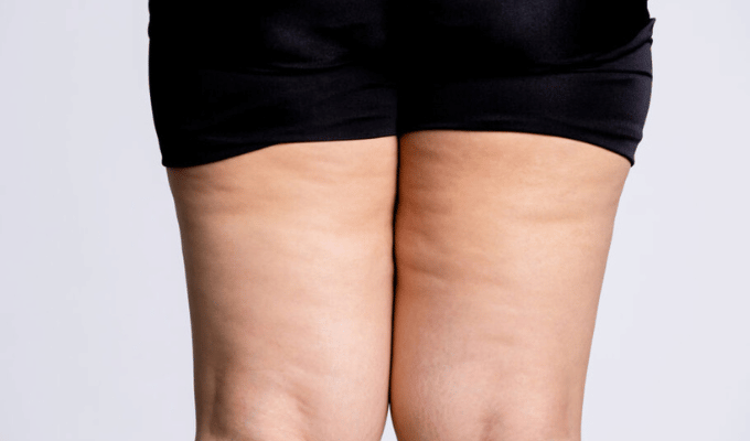 Conoce el lipedema, la enfermedad de la grasa desproporcionada