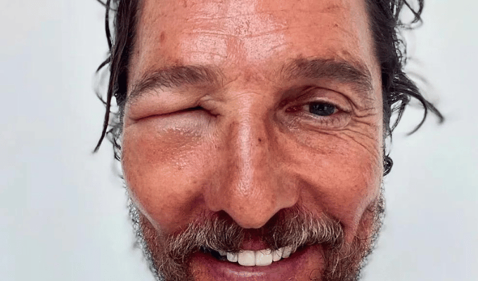 Matthew McConaughey casi irreconocible tras picadura de abeja