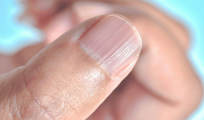 Rayas en las uñas: ¡No las ignores! Consulta a tu médico