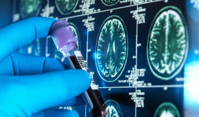 Análisis de sangre detecta Alzheimer con 90% de precisión