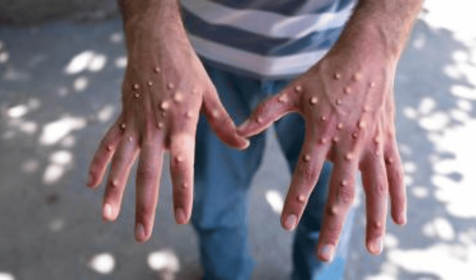 Descubre cómo afectan las ampollas de la viruela del mono
