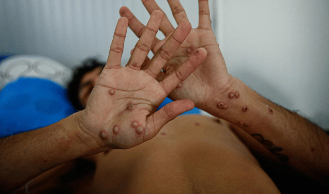 ¡Alerta global! OMS desmiente: Mpox no es el nuevo COVID-19