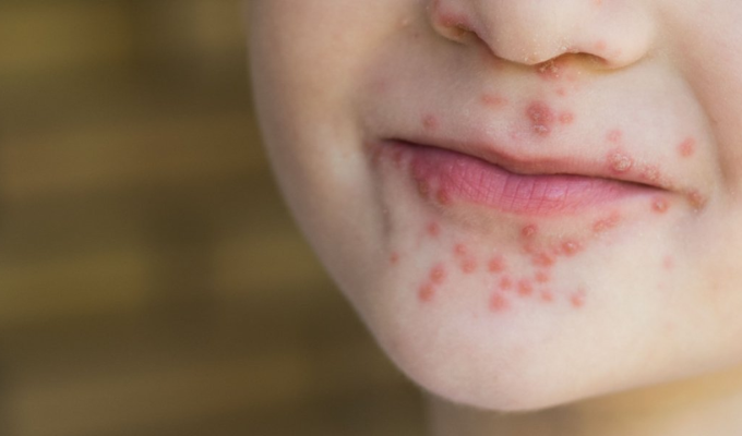 Brote de “manos, pies y boca” alarma a pediatras en Ecuador