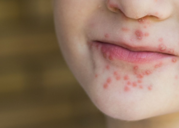 Brote de “manos, pies y boca” alarma a pediatras en Ecuador