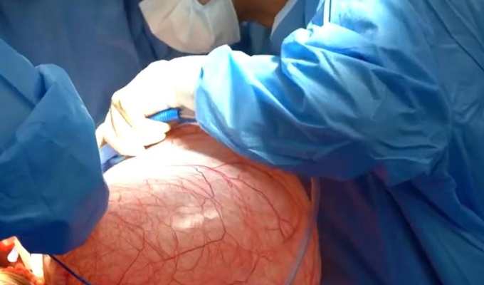 ¡Increíble! Extirpan tumor de 13 kg en Guayaquil 😱🏥