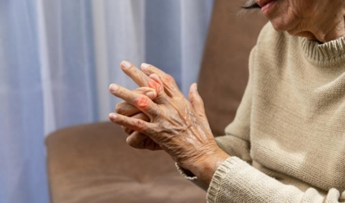 Artrosis: la 'pesadilla' de 1 de cada 5 mujeres mayores de 60 años